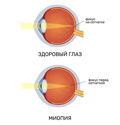 Отслойка сетчатки глаза симптомы и классификация, причины отслойки сетчатки  глаза