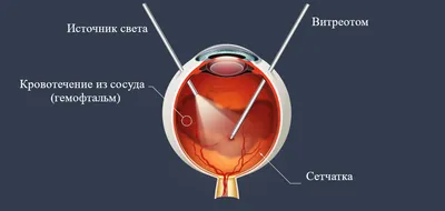 Как предостеречь и лечить гемофтальм (кровоизлияние в глаз) | блог Хирургия  глаза