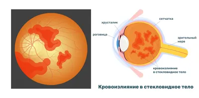 Кровоизлияние в глаз – причины и лечение красного пятна в глазу