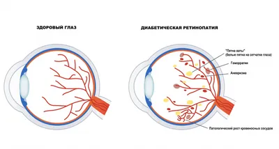 Диабетическая ретинопатия - симптомы и лечение в клинике «Эксимер»