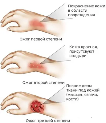 Щетина Человеческом Лице Красные Прыщи Воспаление Щеках Парня Волосы Лице  стоковое фото ©Kinderkz 275351164