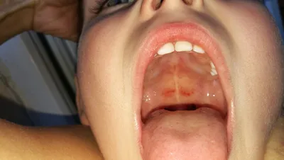 Синяк на нёбе - Вопрос стоматологу - 03 Онлайн