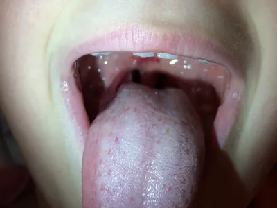 Красные точки на небе у взрослого и ребенка – 1 стоматологическая причина и  10 дополнительных