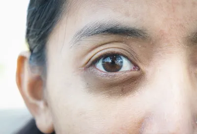 Темные круги под глазами: как избавиться? Почему появляются синяки под  глазами? 📣 - YouTube