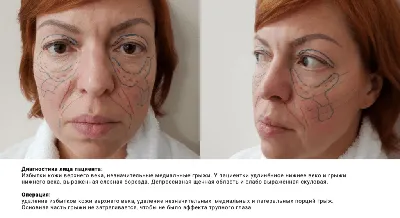 Идеальный кандидат для подтяжки лица - Cosmetic-clinic