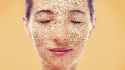 Anna Makarova on Instagram: \"Ксероз - это чрезмерная сухость кожи. Часто  это «платформа» для развития дерматозов (ихтиоз, атопический дерматит и  др). При ксерозе кожа шелушится, появляются трещинки, кожная поверхность  становится грубой и