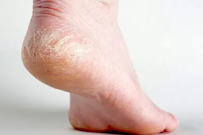 Японские дерматологи протестировали разные способы очищения кожи при  ксерозе | Портал 1nep.ru