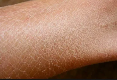 Ксероз кожи: как побороть сухость кожи | Пансионаты «Забота о близких» |  Дзен