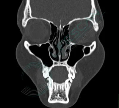 КТ придаточных пазух носа и околоносовых пазух в Киеве - Лайфскан