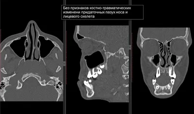 КТ пазух носа, челюсти и ЛОР-органов в Подольске по доступной цене