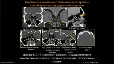 Диагностика пазух носа: околоносовых, придаточных, гайморовых в СПб