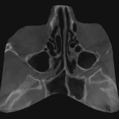 Рентген пазух носа – цена в Москве, сделать рентгенографию носовых пазух в  медицинском центре Медскан