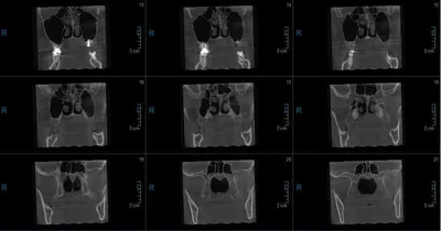 Компьютерная томогорафия придаточных пазух носа - фото - ЛОР в Самаре -  врач Лунёв Андрей Владимирович