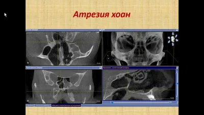 КТ придаточных пазух носа без описания рентгенолога | 3д томография