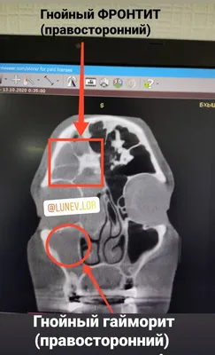 Компьютерная томография придаточных пазух носа | Рентген лаборатория Новая  Жизнь | Дзен