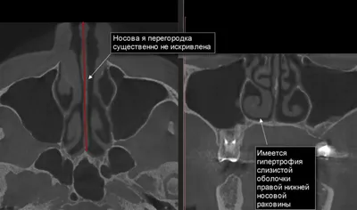 Расшифровка КТ пазух носа | Второе мнение