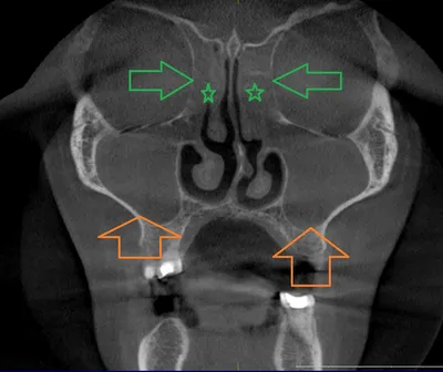 Компьютерная томогорафия придаточных пазух носа - фото - ЛОР в Самаре -  врач Лунёв Андрей Владимирович