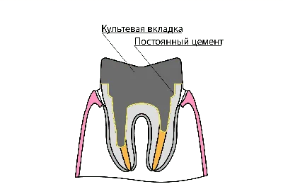 Культевая вкладка под коронку – что это такое, как делают, фото и установка  штифтовой культевой вкладки в зуб