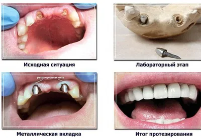 Культевая вкладка - изготовление для зуба под коронку из циркония и других  материалов