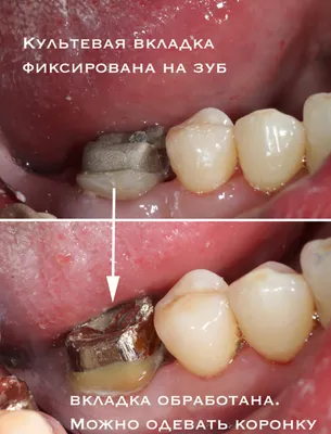 Культевая вкладка под коронку — гарантированный способ сохранить зуб