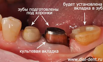 Культевая вкладка: цена установки в Москве, изготовление штифтовой вкладки  в стоматологии