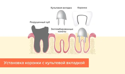 Штифт или культевая вкладка под коронку: что лучше? - YouTube