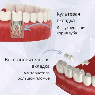 Культевая вкладка под коронку – что это такое, как делают, фото и установка  штифтовой культевой вкладки в зуб