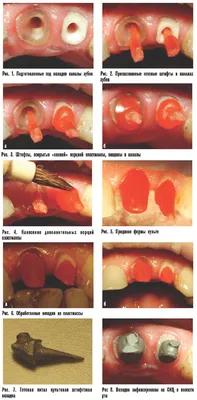 Восстановительные вкладки на зубы. Технология восстановления зубов, их цены  в Москве.
