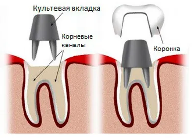 Штифтовые культевые вкладки — Мартынов Дмитрий Викторович