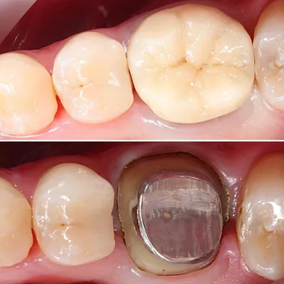 Зубная культевая вкладка под коронку в Феодосии, подготовка зуба к  установке коронки