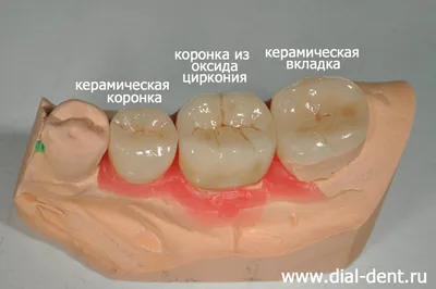 В чем разница между имплантами, штифтами и вкладками? | Стоматология  Smile-at-Once | Дзен