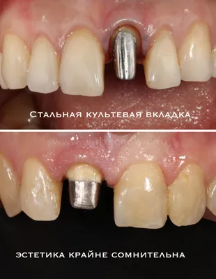 КУЛЬТЕВАЯ ВКЛАДКА СПАСЛА РАЗРУШЕННЫЙ НА 2/3 СОБСТВЕННЫЙ ЗУБ! -  Стоматологическая клиника Лазурит