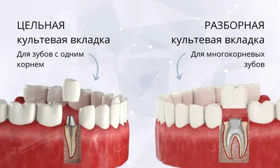 Зубная культевая вкладка: что это, виды, плюсы и минусы — Хирургическая  Стоматология