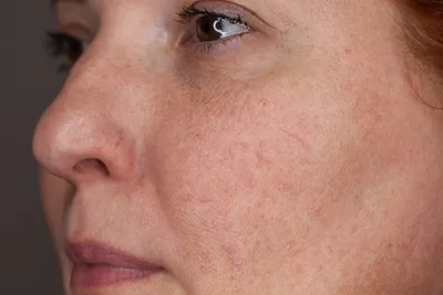 Купероз кожи лица: что это такое, причины и симптомы, способы лечения |  Статья | Томск «Доктор Борменталь»