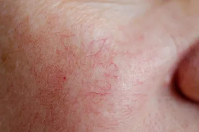 Как удалить купероз на лице: фотоомоложение на аппарате bbl – отзывы |  Beauty Insider