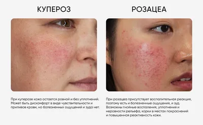 Проблемы кожи лица (купероз, черные точки, морщины): причины возникновения,  профилактика, устранение