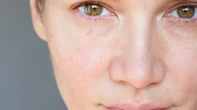 Купероз на лице - причины и способы профилактики | Lifting Lab