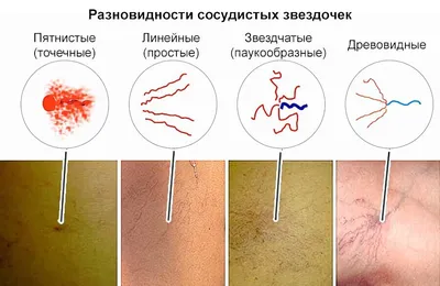 Купероз. Что делать с сосудистыми звездочками на коже? | Блог о  косметологии BUYBEAUTY