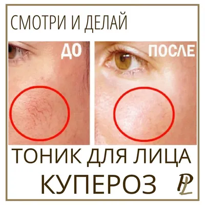 Лечение купероза в СПб - от 6000р в Клинике MED LOVE