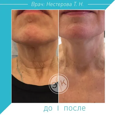 Коррекция мимических морщин Диспорт, Ксеомин экспертного класса — GGbeauty