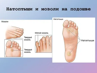Мозоль: лечение и удаление сухой мозоли со стержнем на ногах, натоптышей на  пятках - Medside.ru