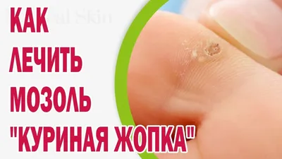 Как лечить мозоль \"куриная жопка\" - YouTube