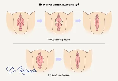 Лабиопластика в Минске | Медицинский центр Эра