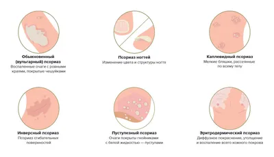 Лечение псориаза в Киеве Лечение псориаза стволовыми клетками Good Cells