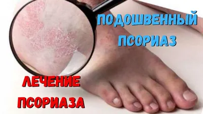 Какого псориаза только не бывает. Формы, виды | Psoriaz.Life | Дзен