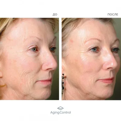 Laser face resurfacing - Coolaser Clinic