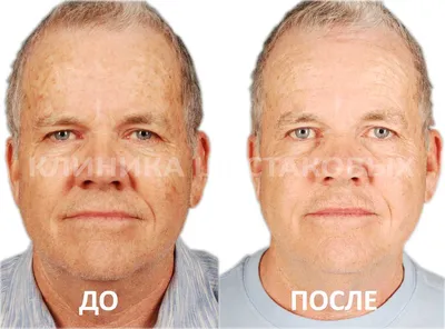 Лазерная шлифовка лица в Москве | Damas Medical Center