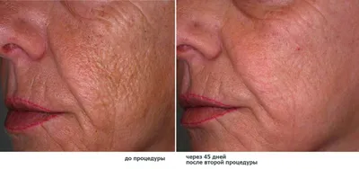 Фотографии до и после лазерного омоложения кожи Fraxel, проводим в клинике  Premium Aesthetics