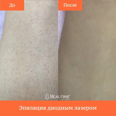 Мужская эпиляция и депиляция в SkinLazerMed