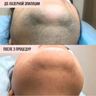 Лазерная эпиляция рук – фотографии до и после